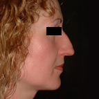 Rhinoplastie