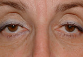 Blépharoplastie